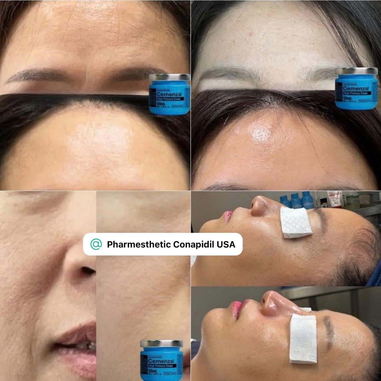 Pharmesthetics Cemenzal High Potency Cream-50mL Upgraded