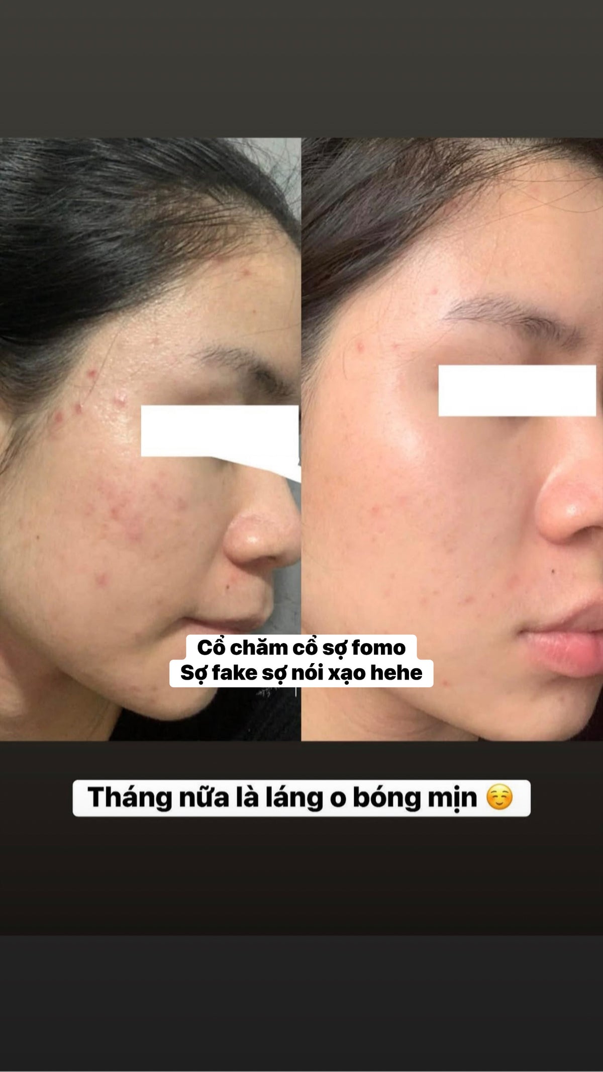Routine mụn KS