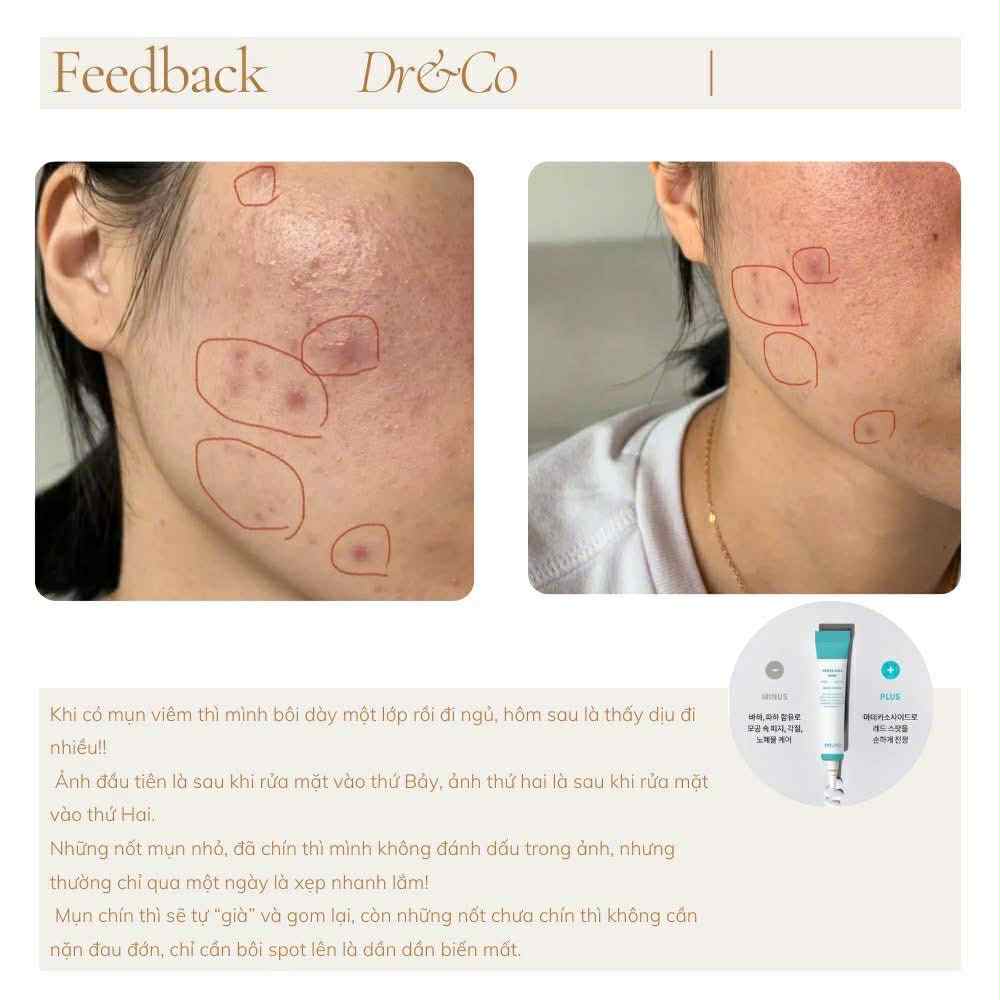 Triple CiCa Spot – Tinh chất chấm mụn mát lạnh- sản phẩm của viện da HQ