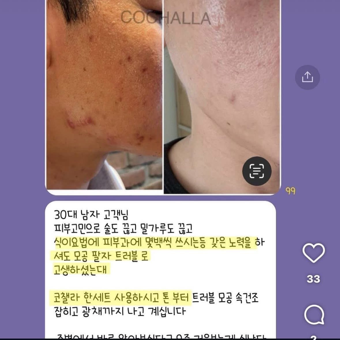 Cochalla set điều trị vấn đề da ngày đêm ngắn gọn bước mụn nám tàn nhang đốm nâu sắc tố