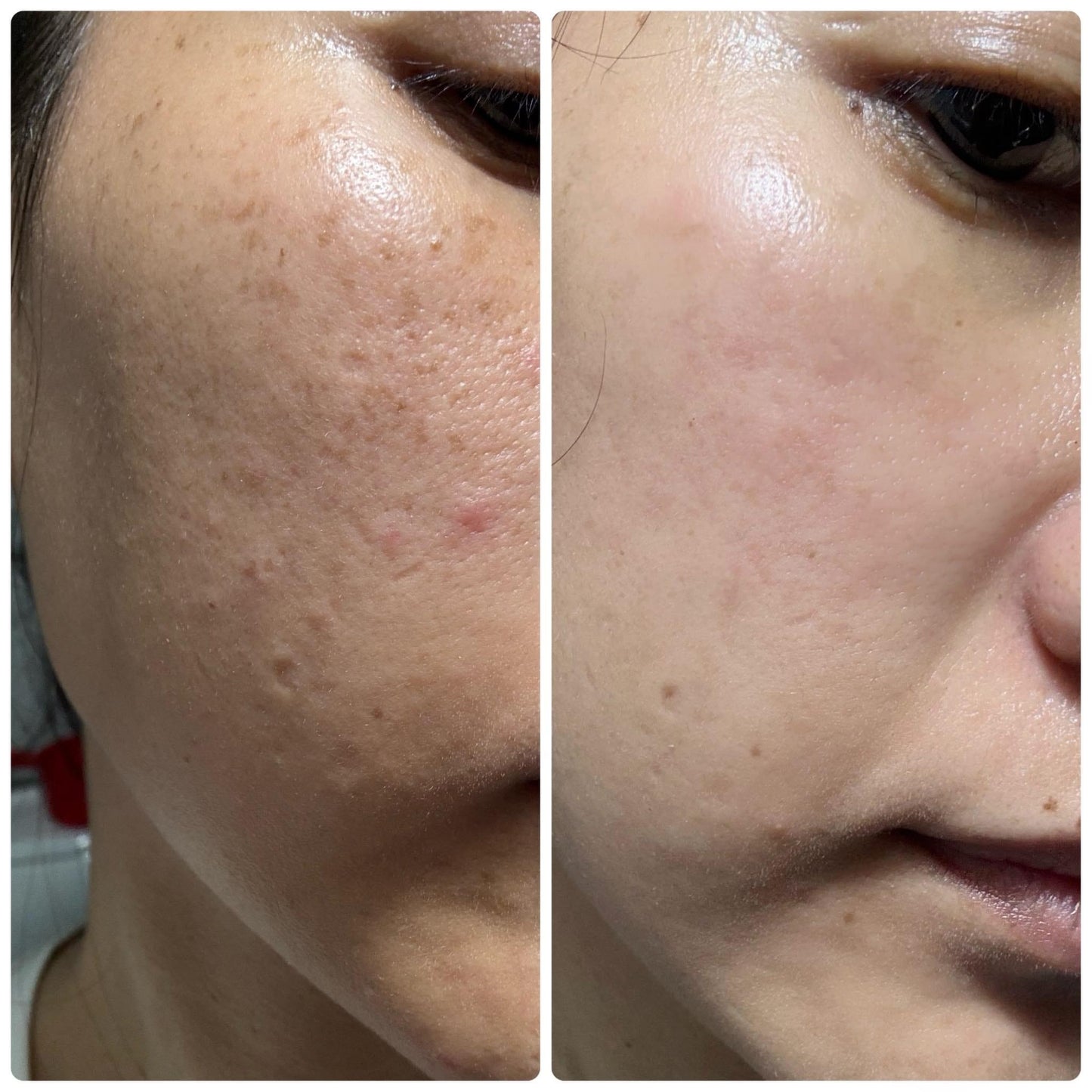 Acne Serum Rosie Center - Serum Trị Mụn NUTRIPEONY