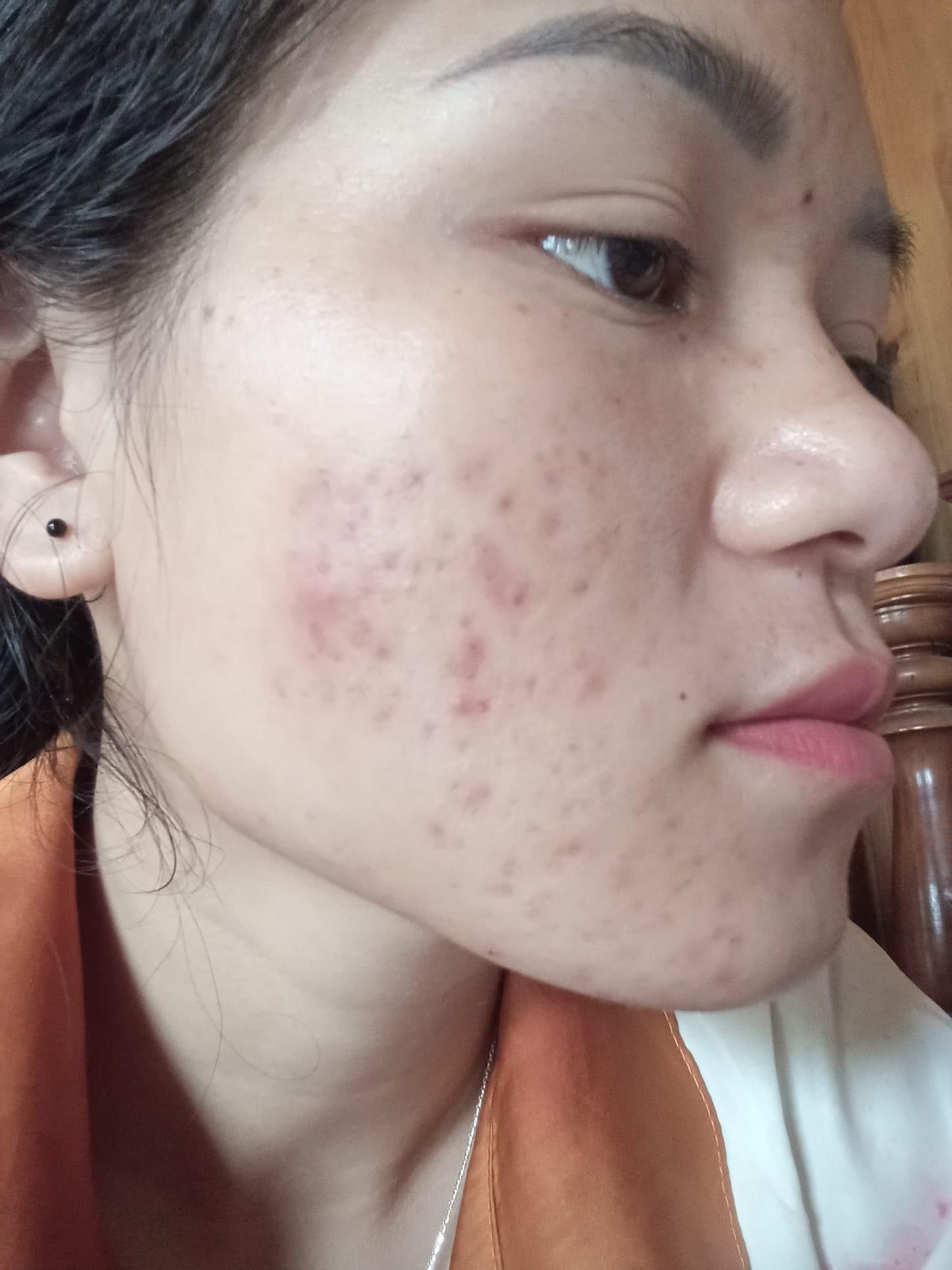 Acne Serum Rosie Center - Serum Trị Mụn NUTRIPEONY