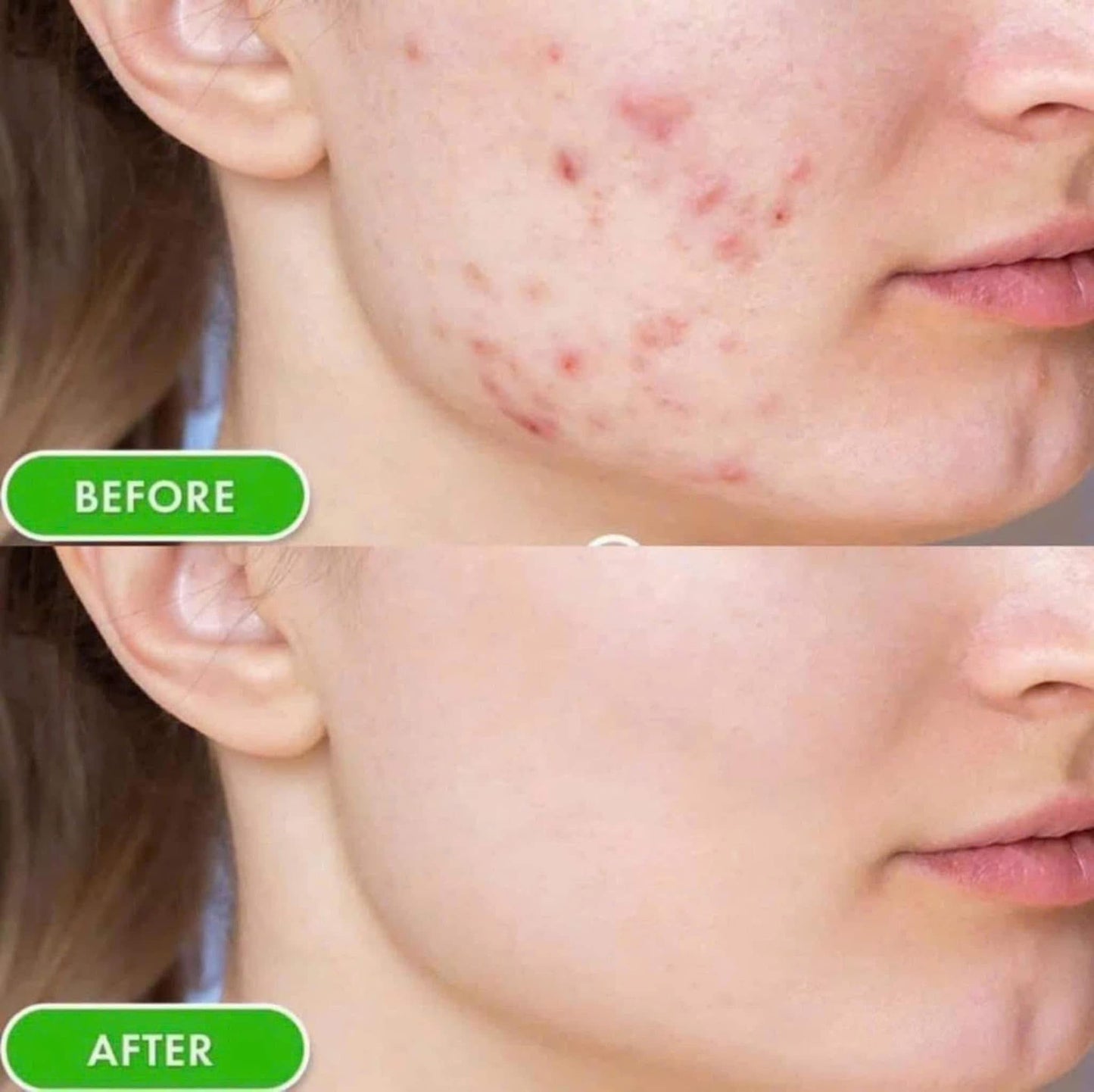 Serum Phyto calm Thâm mụn lỗ chân lông to