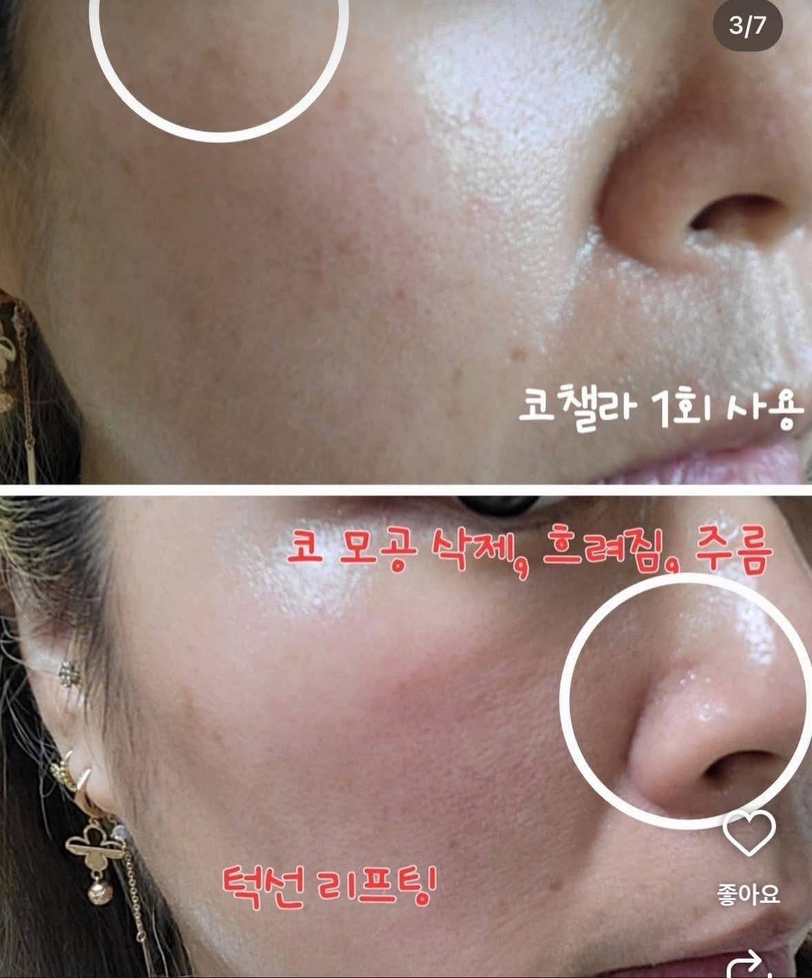 Cochalla set điều trị vấn đề da ngày đêm ngắn gọn bước mụn nám tàn nhang đốm nâu sắc tố