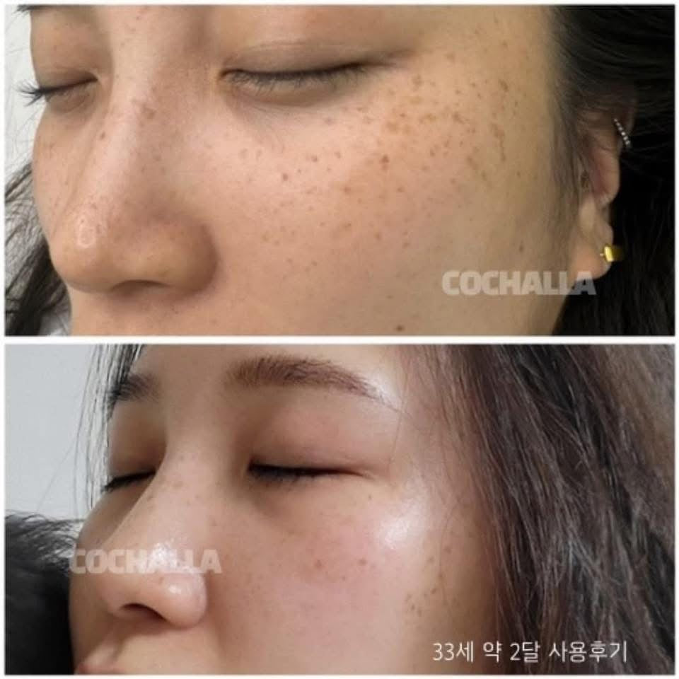 Cochalla set điều trị vấn đề da ngày đêm ngắn gọn bước mụn nám tàn nhang đốm nâu sắc tố