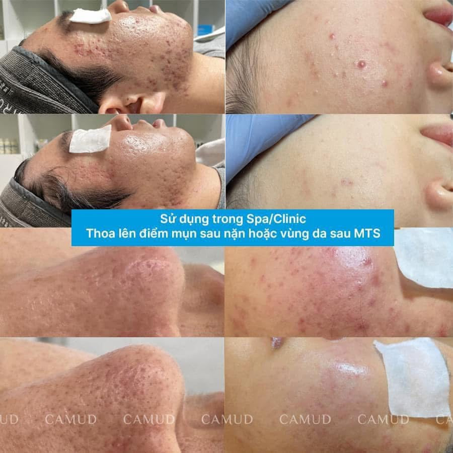Pharmesthetic Fixcica 13grams gel chấm thâm mụn vết thương hở