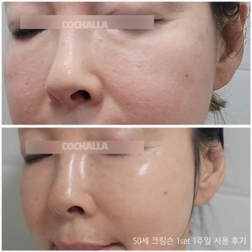 Cochalla set điều trị vấn đề da ngày đêm ngắn gọn bước mụn nám tàn nhang đốm nâu sắc tố